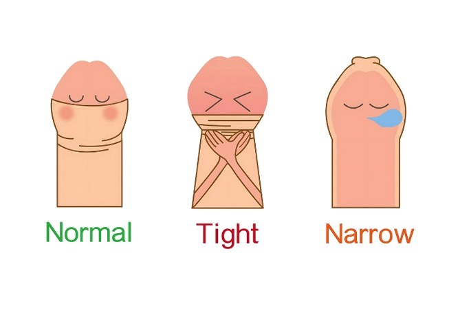Phimosis (Tight Foreskin): Symptoms and Treatment Options